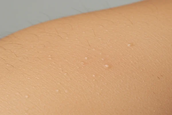 Keratosis Pilaris: Smoother Skin for Men in 2026
